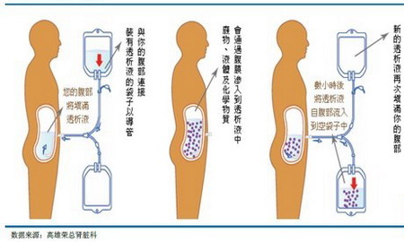 腹膜透析示意图 腹膜透析示意图