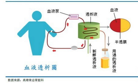 血液透析示意图 血液透析示意图