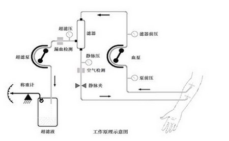 FQ-16心衰超滤脱水装置工作原理示意图 FQ-16心衰超滤脱水装置工作原理示意图