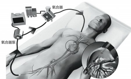 人工膜肺设备ECMO关键时刻能挽救五大猝死病患者生命 人工膜肺设备ECMO关键时刻能挽救五大猝死病患者生命
