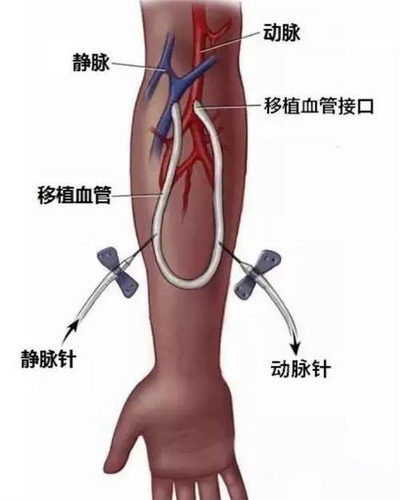 减少痛苦上海市浦东新区周浦医院引进血透内瘘修护仪 减少痛苦上海市浦东新区周浦医院引进血透内瘘修护仪