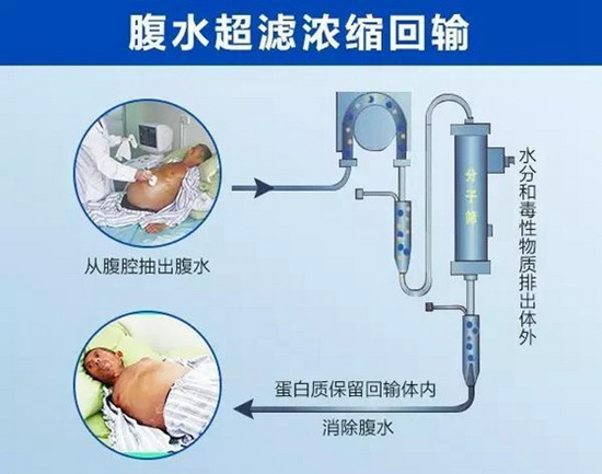 栖霞市中医医院血液净化室开展腹水超滤浓缩回输诊疗 栖霞市中医医院血液净化室开展腹水超滤浓缩回输诊疗