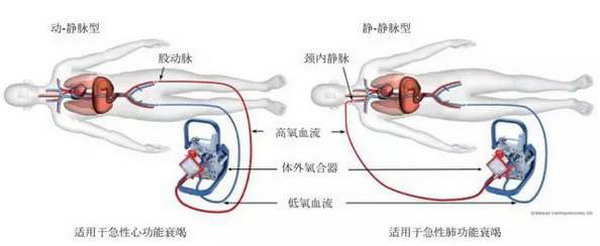 体外膜肺氧合（ECMO）