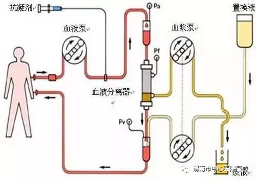 渭南市中心医院肾病内科血透室开展血浆置换术获成功