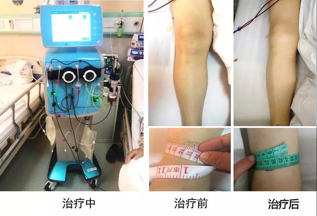 西安市第三医院成功进行首例急性失代偿心衰超滤治疗 西安市第三医院成功进行首例急性失代偿心衰超滤治疗
