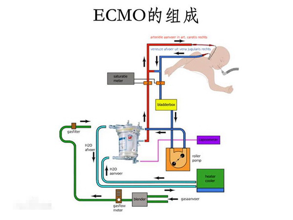 杭州邵逸夫医院ECMO团队驰援余姚抢救中毒性肺炎患者